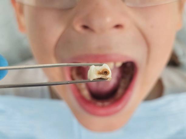 Best Emergency Dental Extractions in Bay Hill, FL